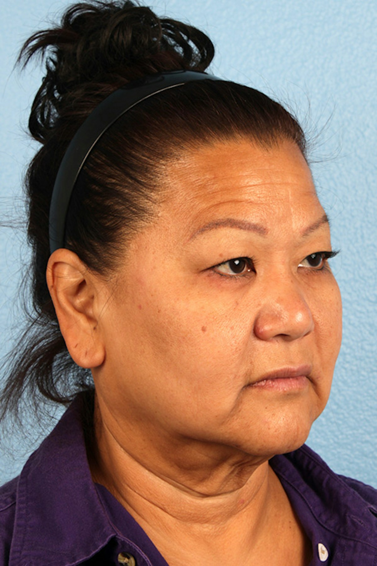 Facelift Before & After Gallery - Patient 443971 - Image 3