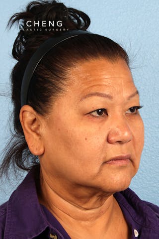 Hidden Patients Before & After Gallery - Patient 339411 - Image 3