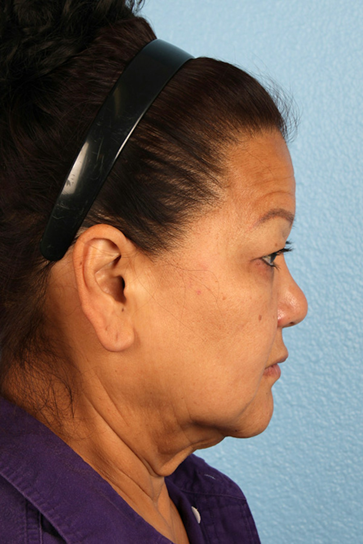 Facelift Before & After Gallery - Patient 443971 - Image 5