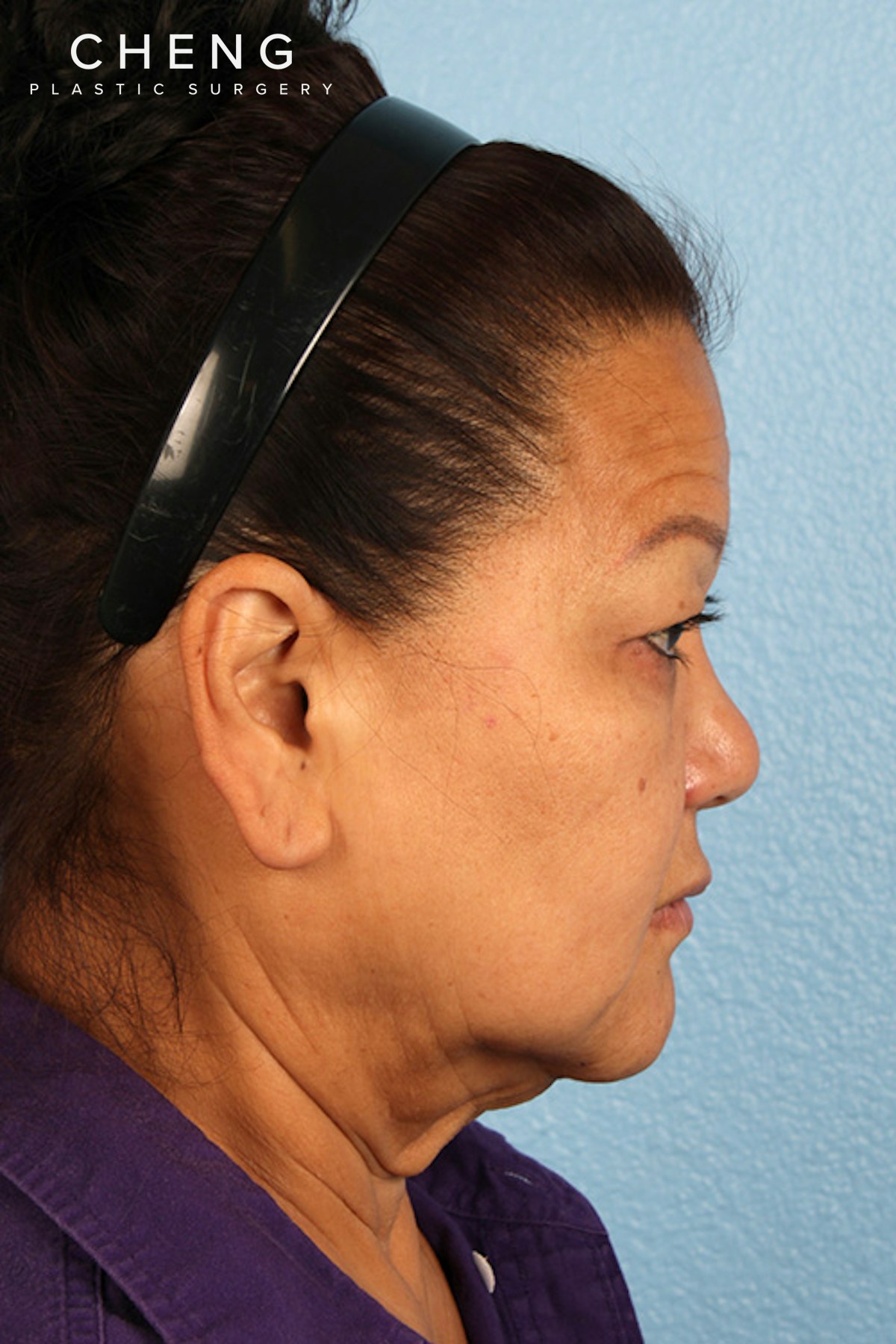 Hidden Patients Before & After Gallery - Patient 878710 - Image 5