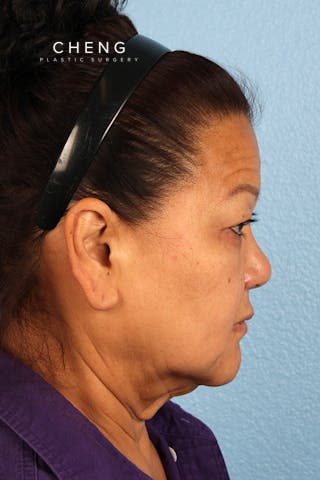 Hidden Patients Before & After Gallery - Patient 339411 - Image 5