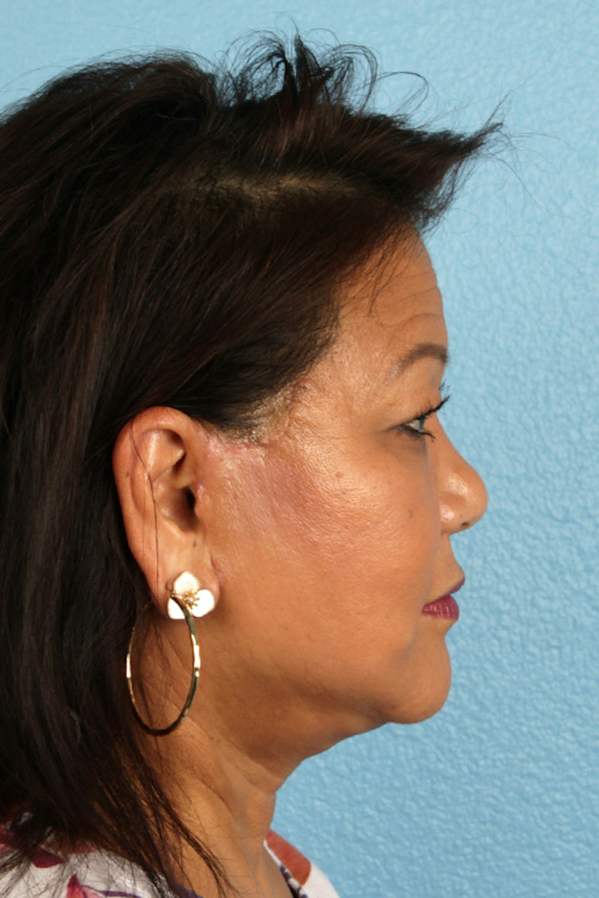 Facelift Before & After Gallery - Patient 443971 - Image 6