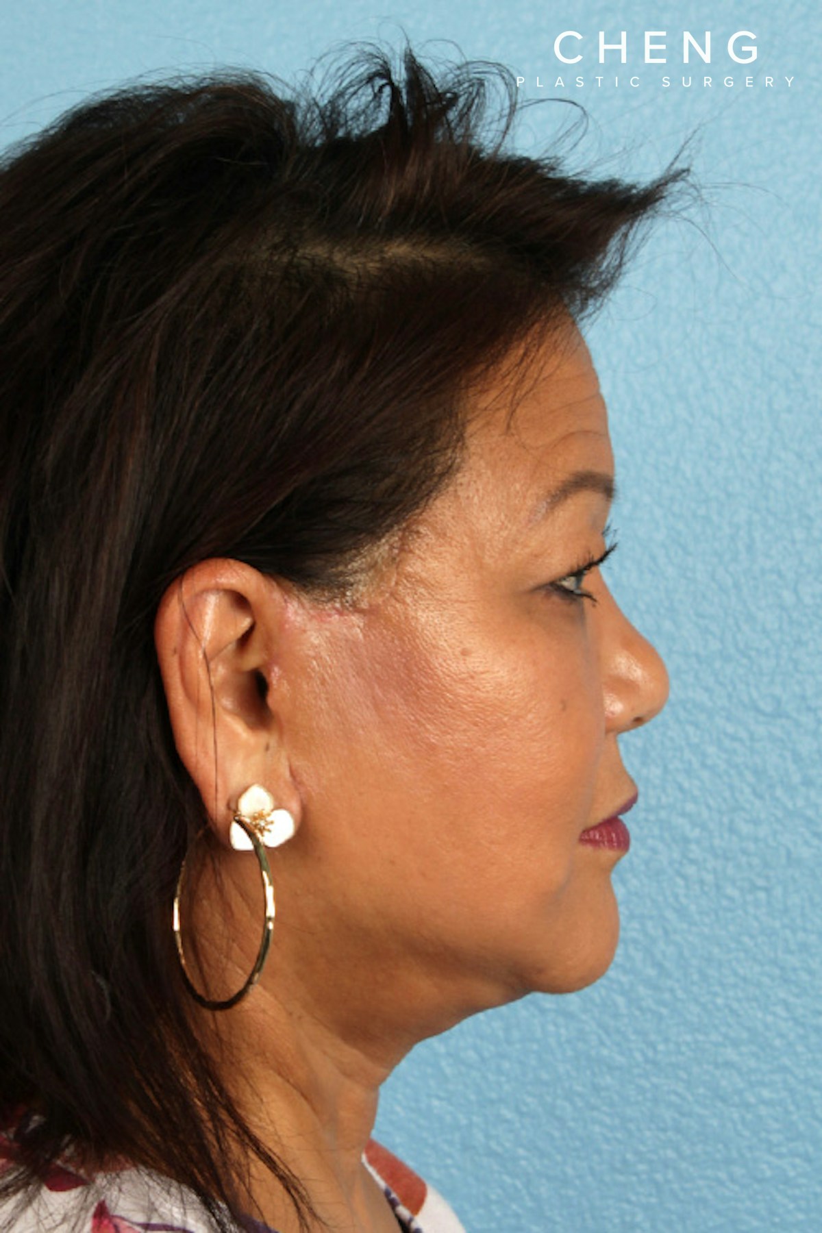 Hidden Patients Before & After Gallery - Patient 878710 - Image 6