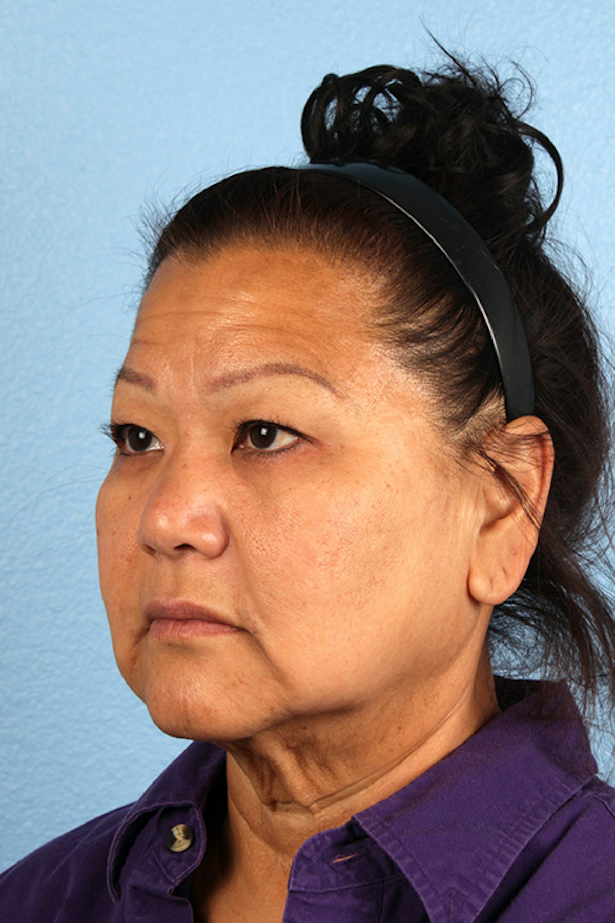 Facelift Before & After Gallery - Patient 443971 - Image 7