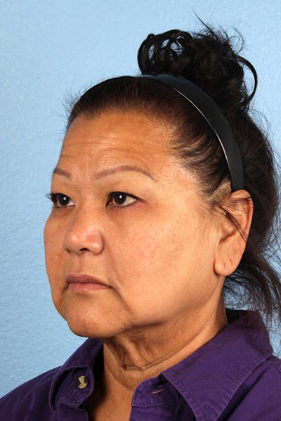Neck Lift Before & After Gallery - Patient 196183 - Image 1
