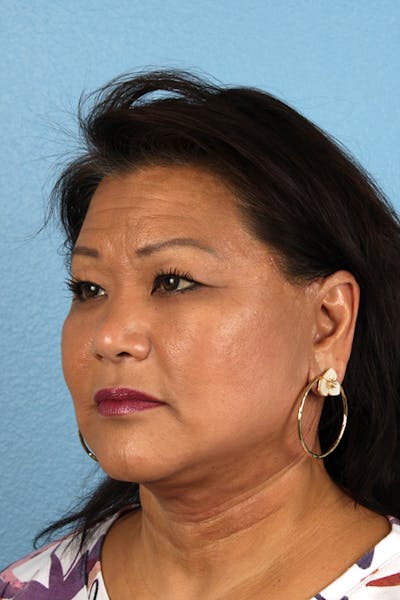 Neck Lift Before & After Gallery - Patient 196183 - Image 2