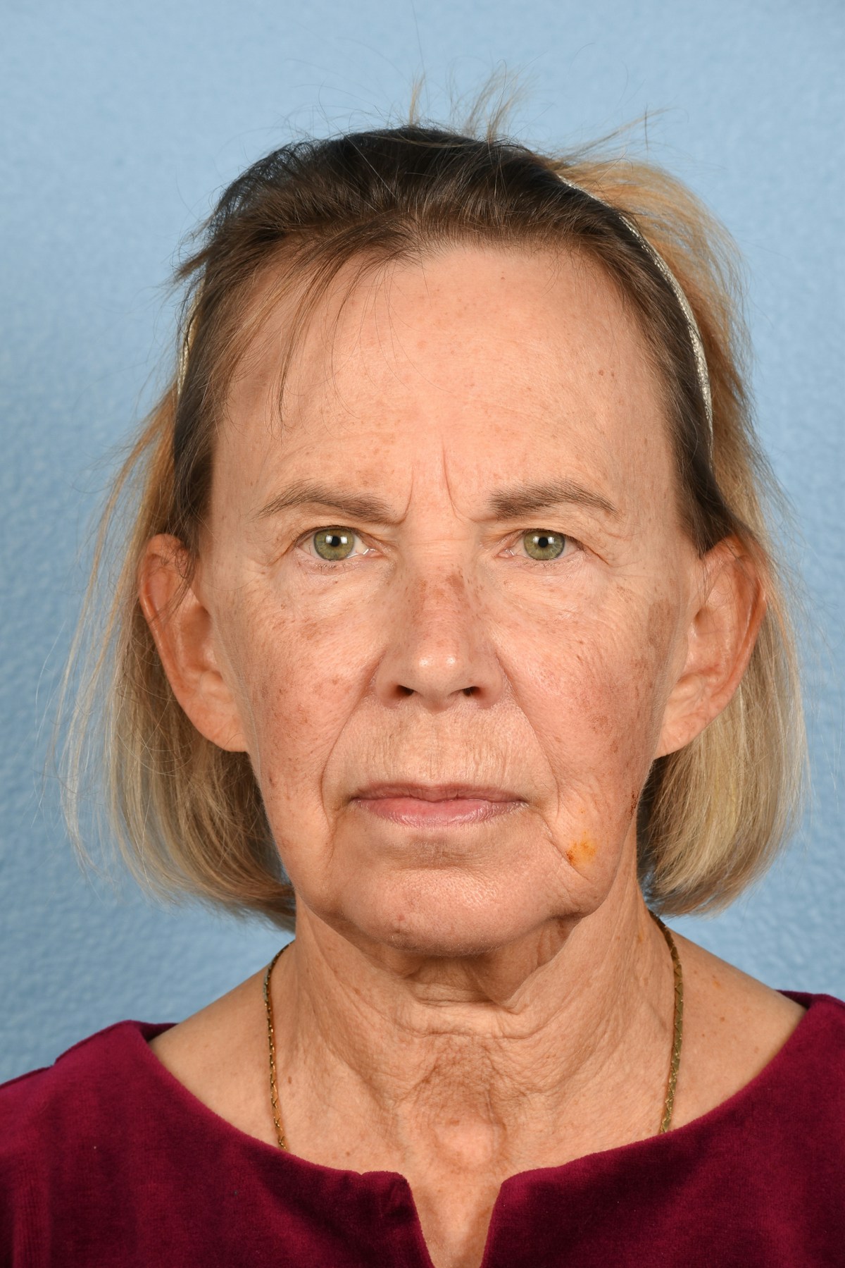 Facelift Before & After Gallery - Patient 372074 - Image 1