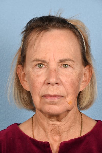Facelift Before & After Gallery - Patient 372074 - Image 1
