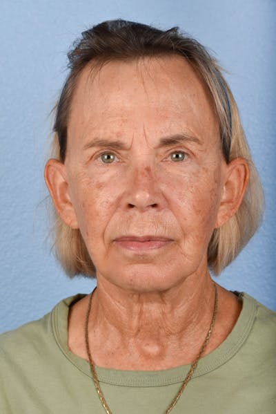 Facelift Before & After Gallery - Patient 372074 - Image 2