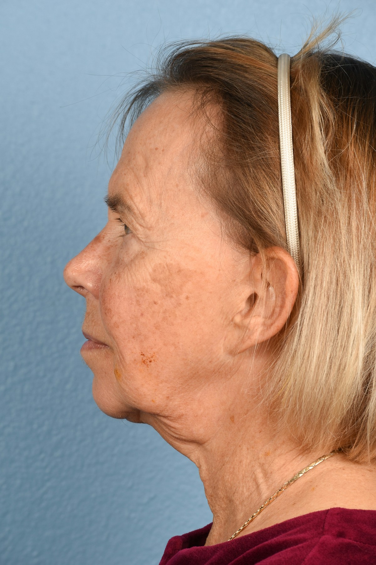 Facelift Before & After Gallery - Patient 372074 - Image 5