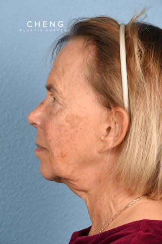 Hidden Patients Before & After Gallery - Patient 616456 - Image 5