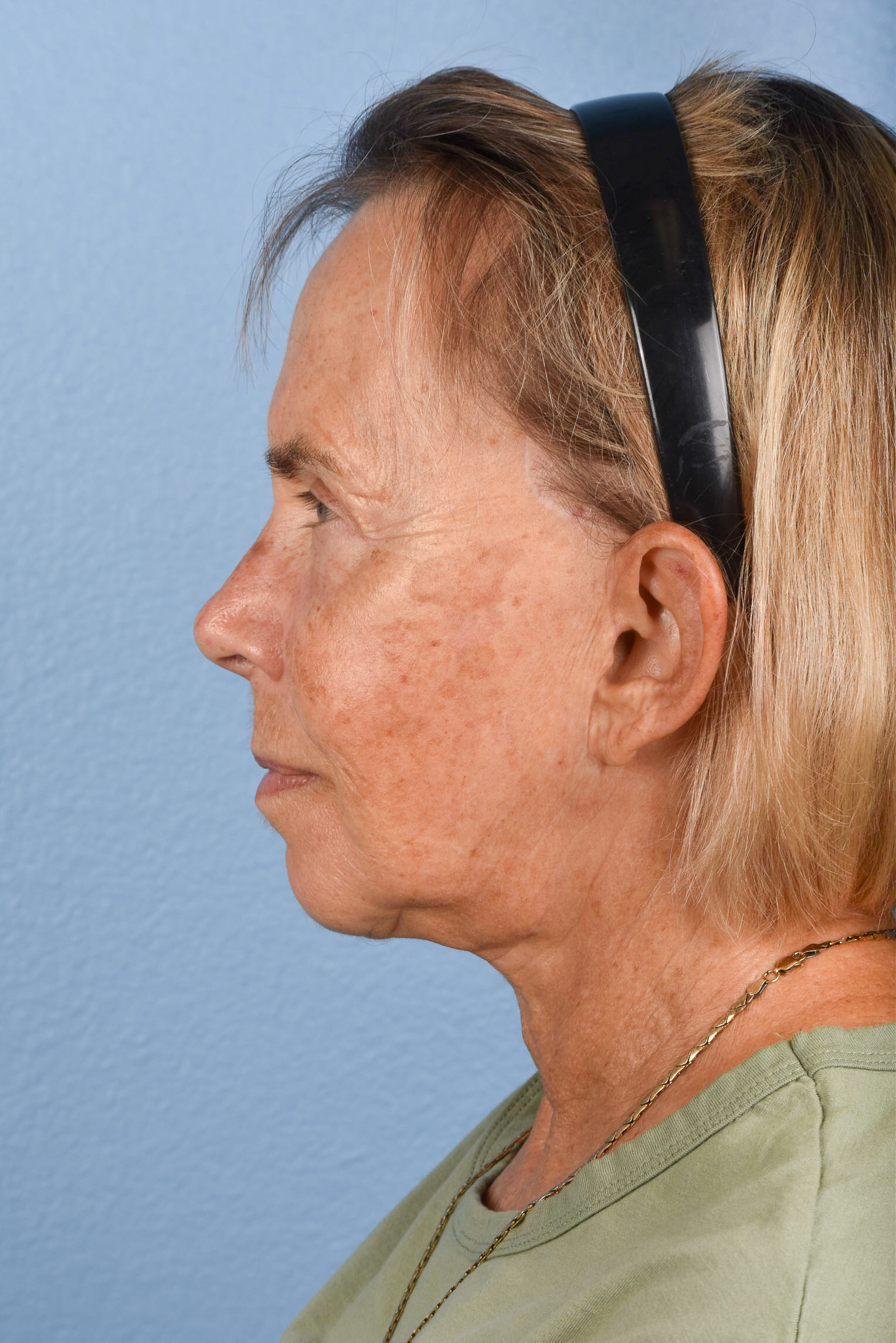 Neck Lift Before & After Gallery - Patient 310482 - Image 6