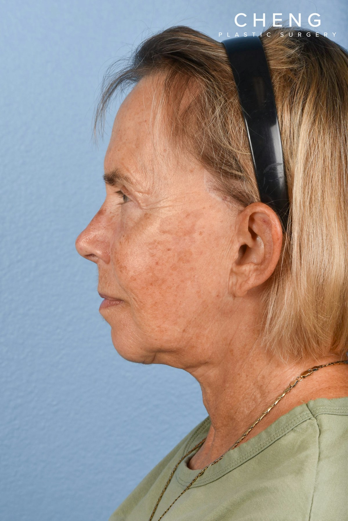 Hidden Patients Before & After Gallery - Patient 616456 - Image 6