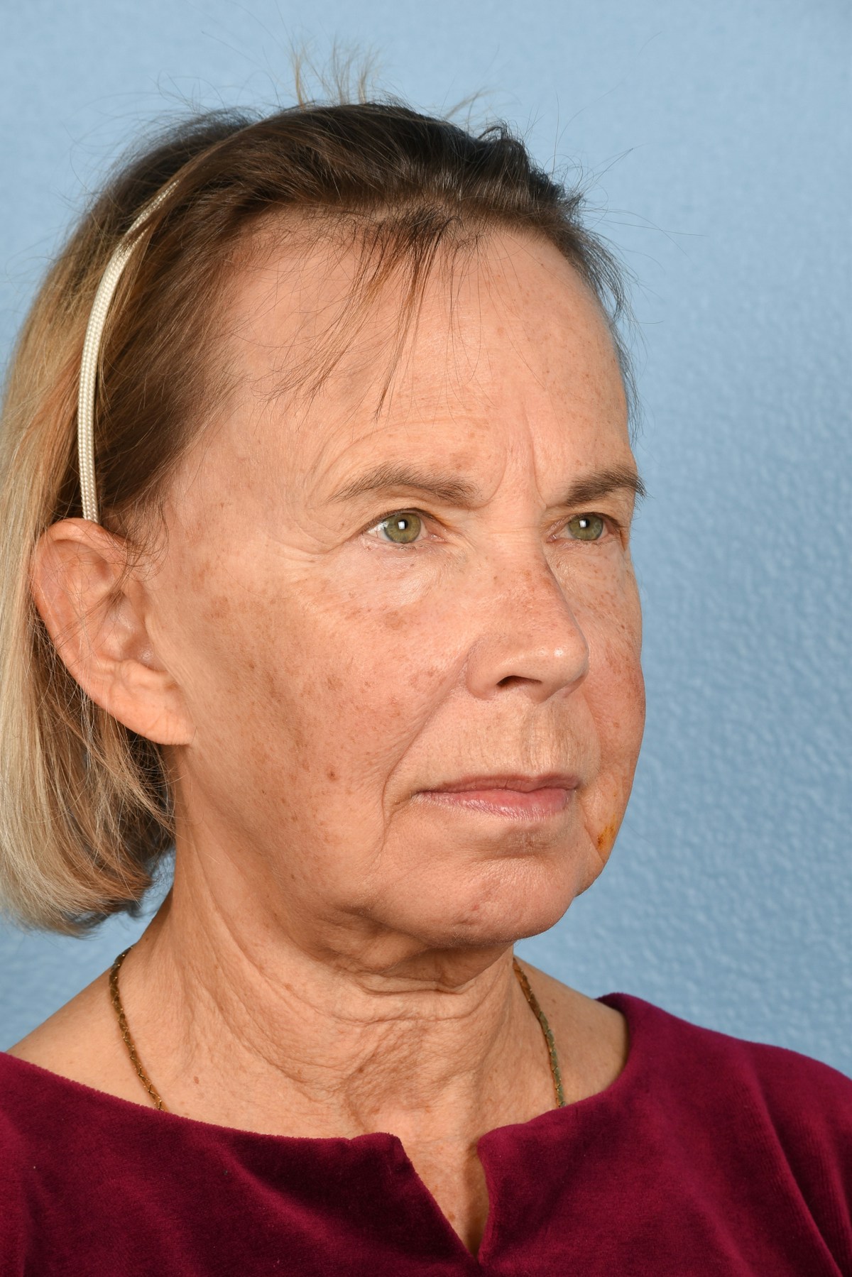Facelift Before & After Gallery - Patient 372074 - Image 7