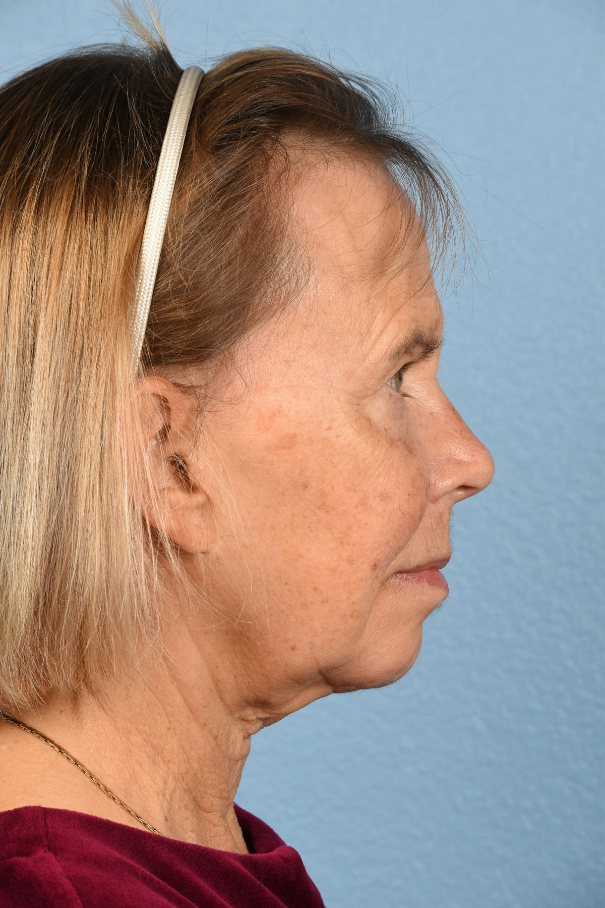 Facelift Before & After Gallery - Patient 372074 - Image 9