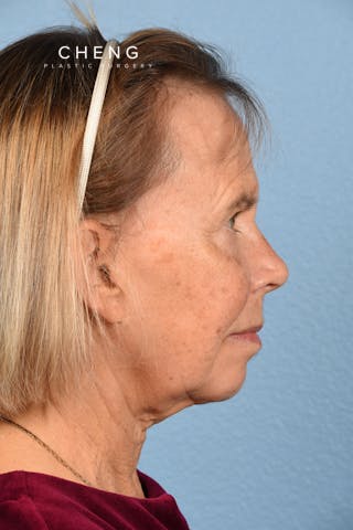 Hidden Patients Before & After Gallery - Patient 616456 - Image 9