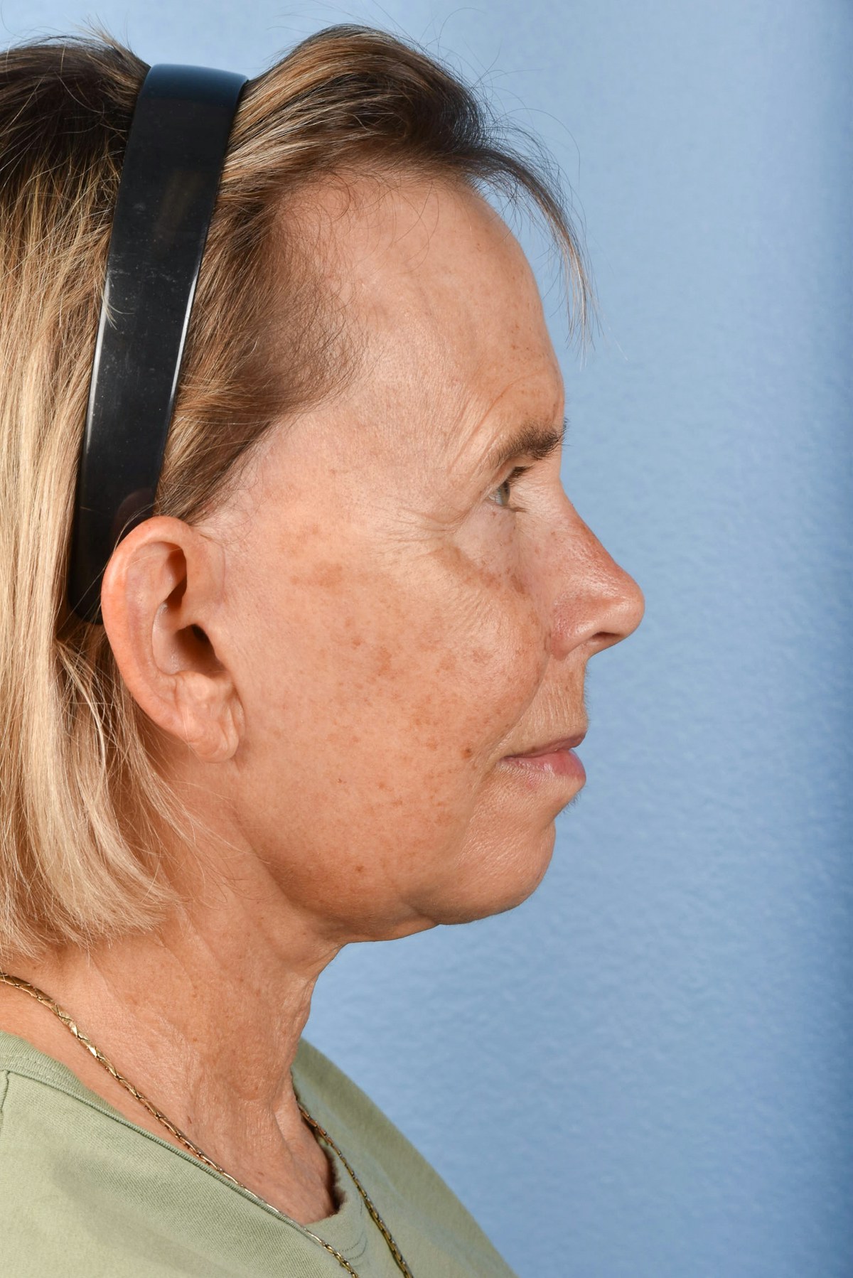 Facelift Before & After Gallery - Patient 372074 - Image 10