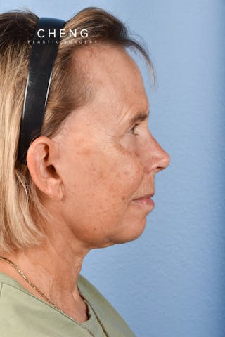 Hidden Patients Before & After Gallery - Patient 616456 - Image 10