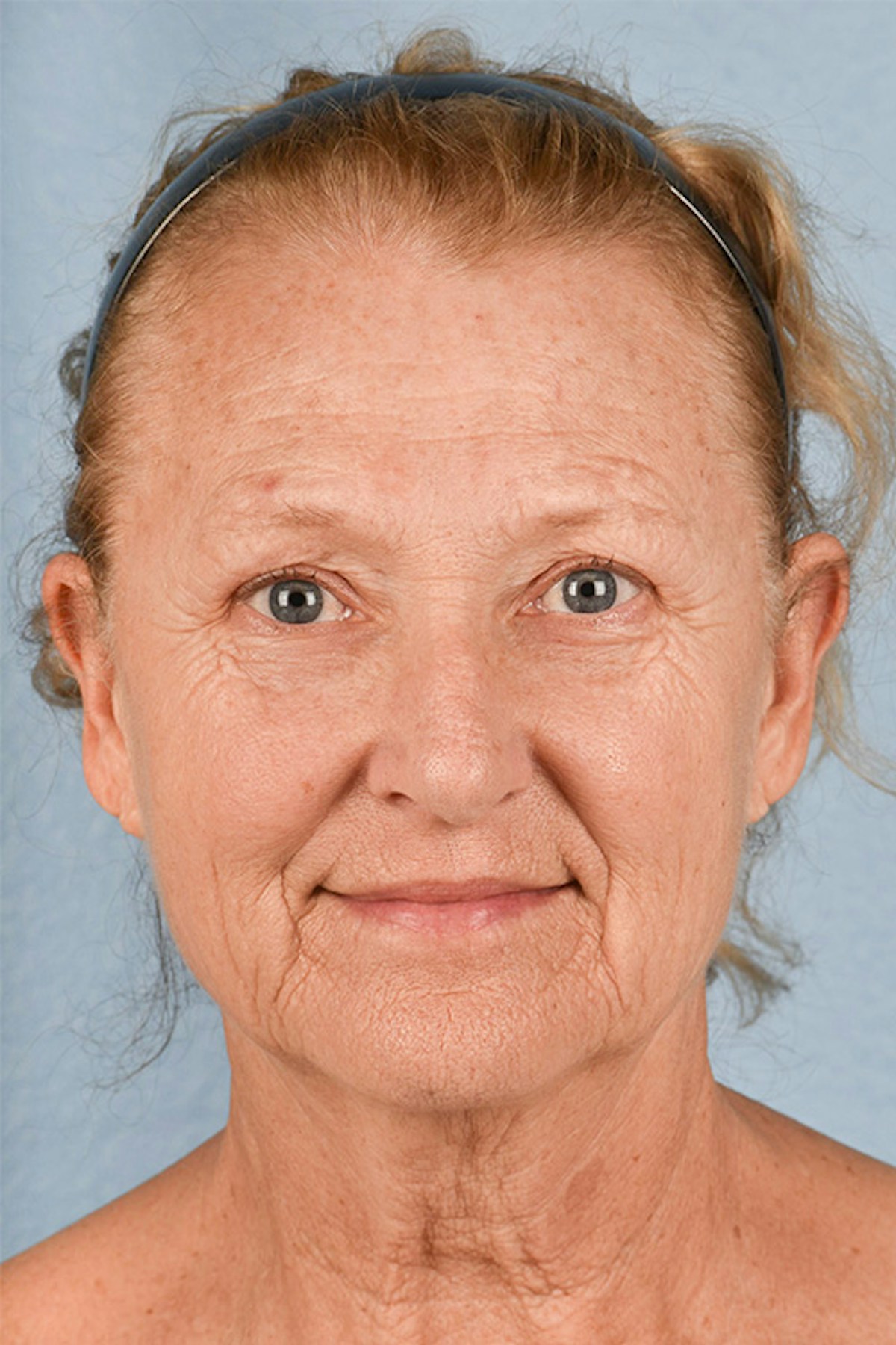 Facelift Before & After Gallery - Patient 853105 - Image 1
