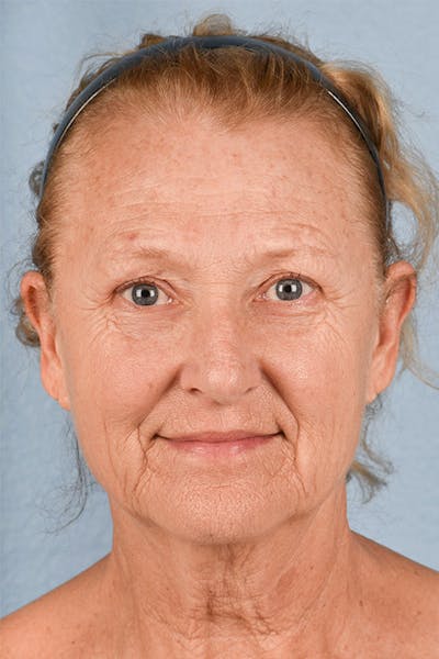 Facelift Before & After Gallery - Patient 853105 - Image 1