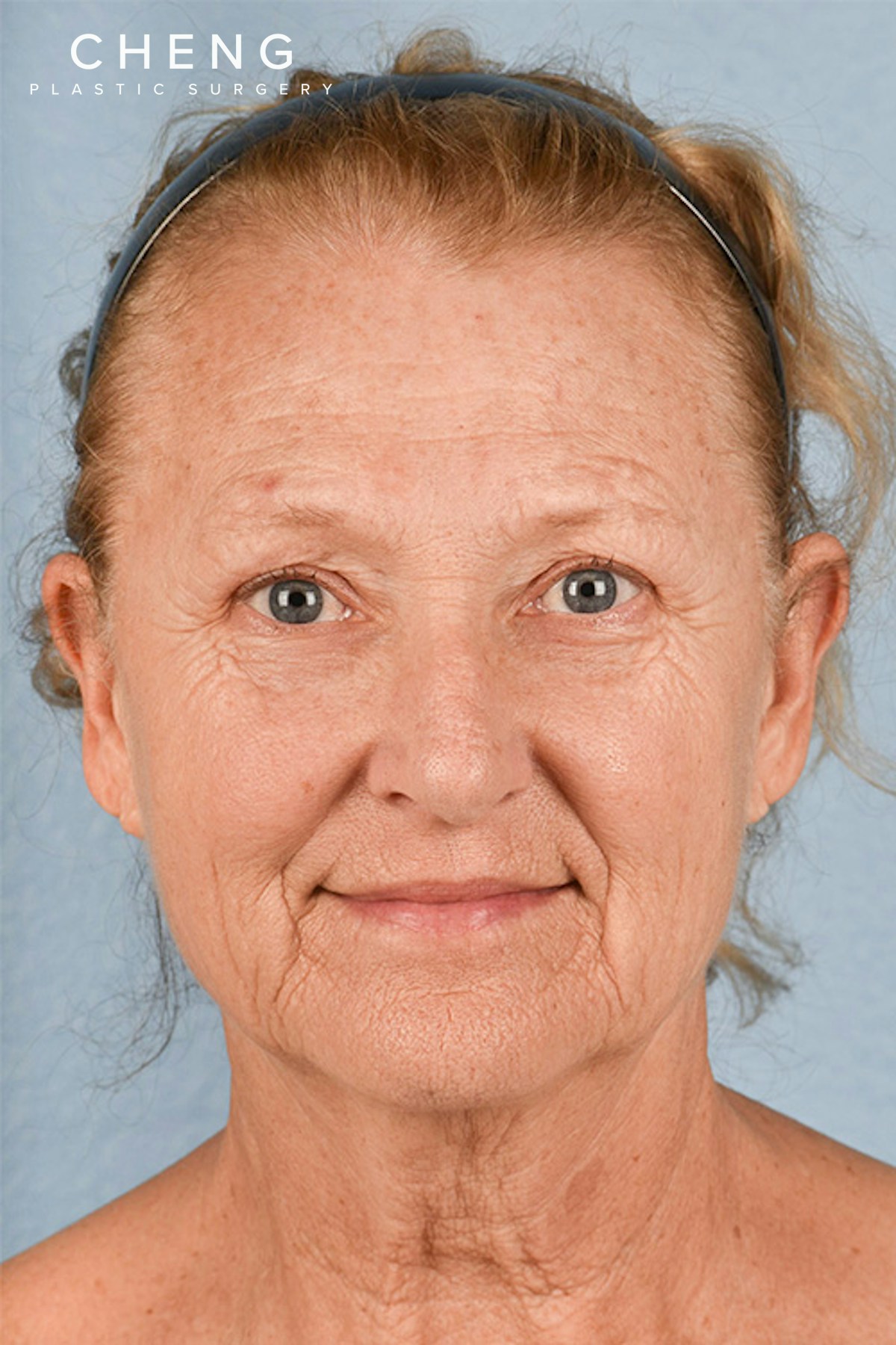 Hidden Patients Before & After Gallery - Patient 392572 - Image 1