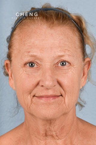 Hidden Patients Before & After Gallery - Patient 392572 - Image 1