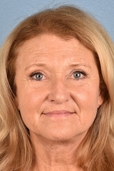 Facelift Before & After Gallery - Patient 853105 - Image 2