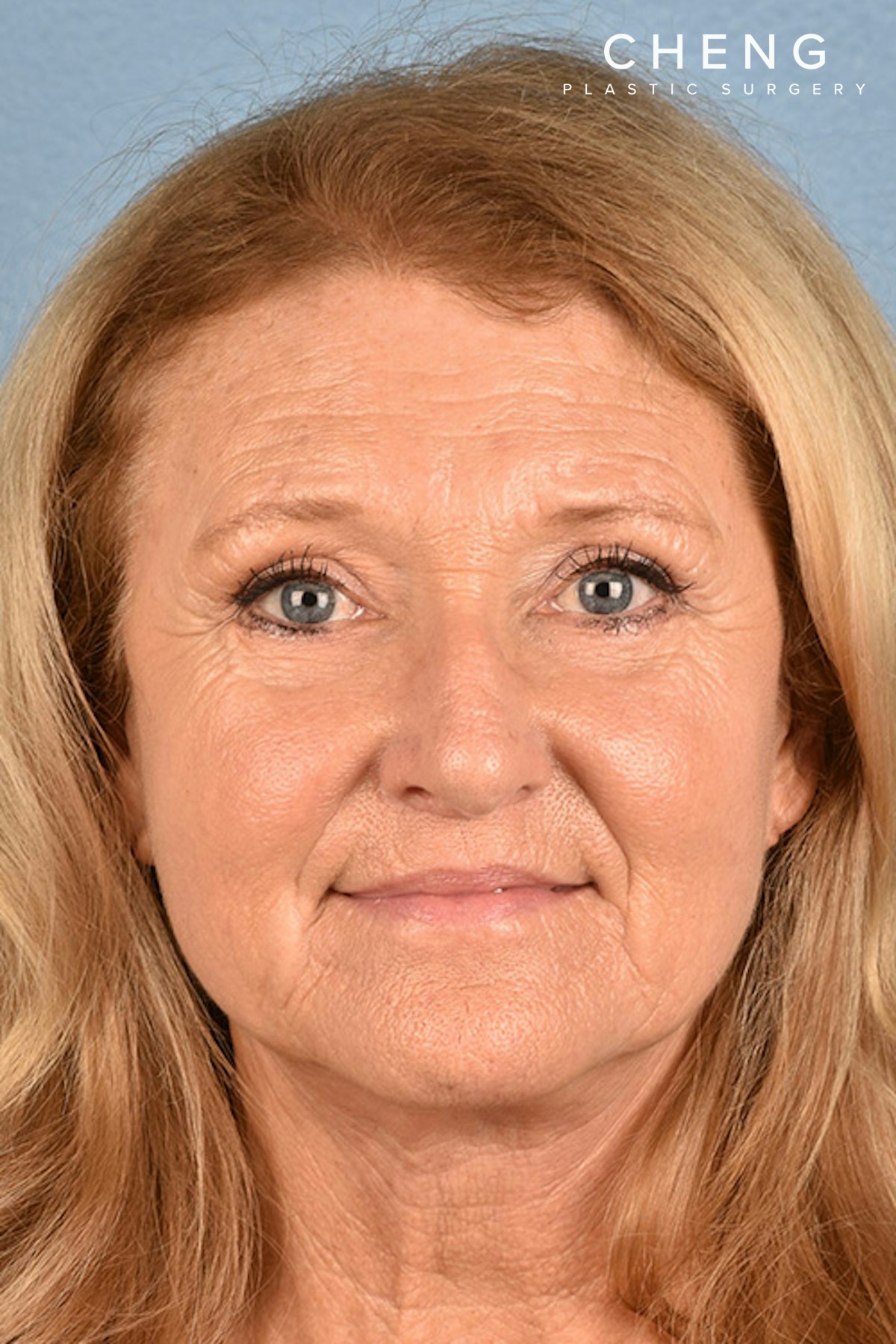 Hidden Patients Before & After Gallery - Patient 392572 - Image 2