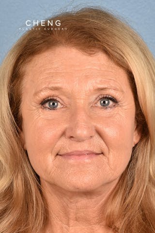 Hidden Patients Before & After Gallery - Patient 392572 - Image 2