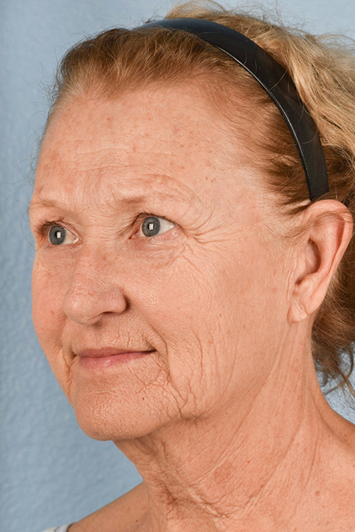 Facelift Before & After Gallery - Patient 853105 - Image 3