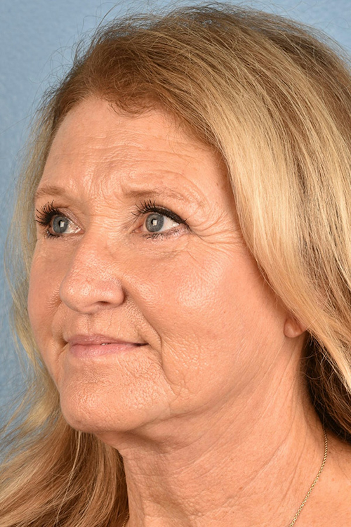 Facelift Before & After Gallery - Patient 853105 - Image 4