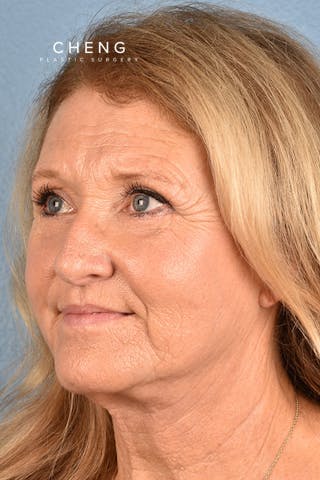 Hidden Patients Before & After Gallery - Patient 392572 - Image 4