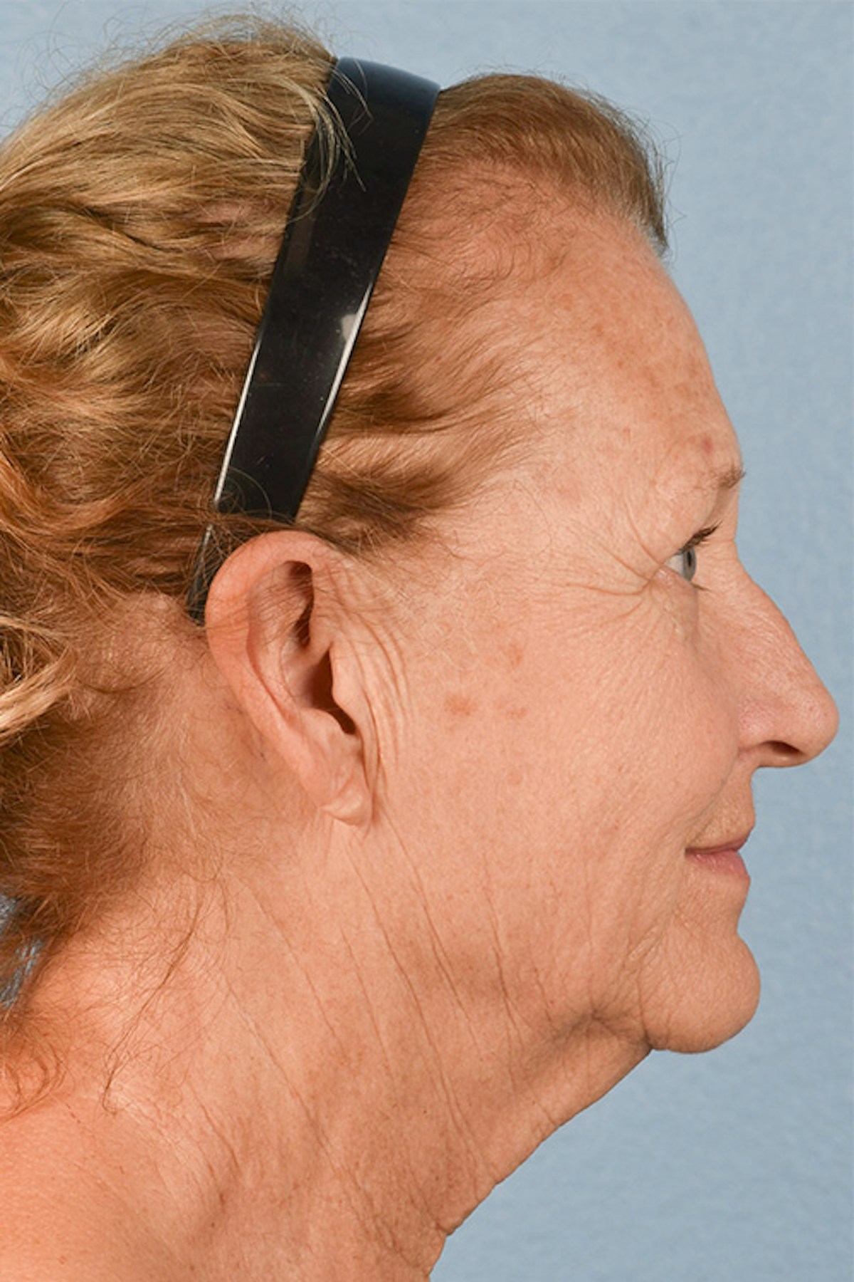 Facelift Before & After Gallery - Patient 853105 - Image 5
