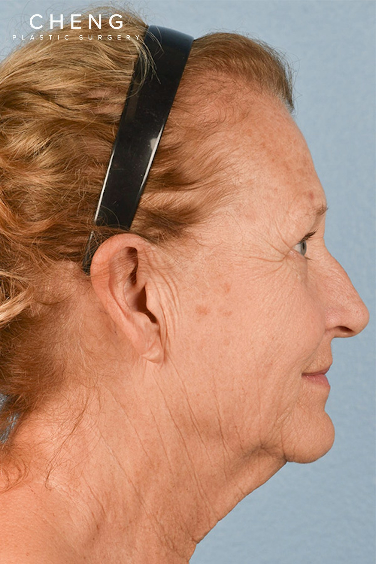 Hidden Patients Before & After Gallery - Patient 392572 - Image 5