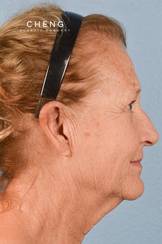 Hidden Patients Before & After Gallery - Patient 392572 - Image 5