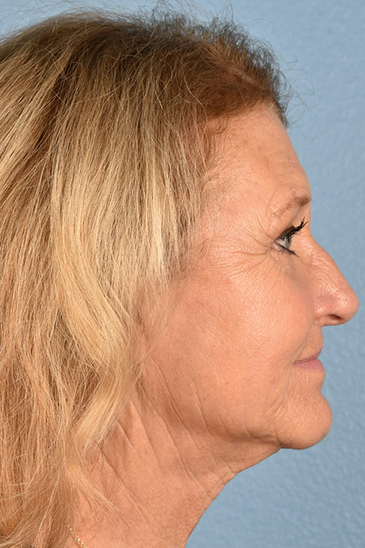 Facelift Before & After Gallery - Patient 853105 - Image 6