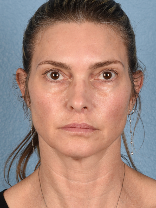 Facelift Before & After Gallery - Patient 127422 - Image 1