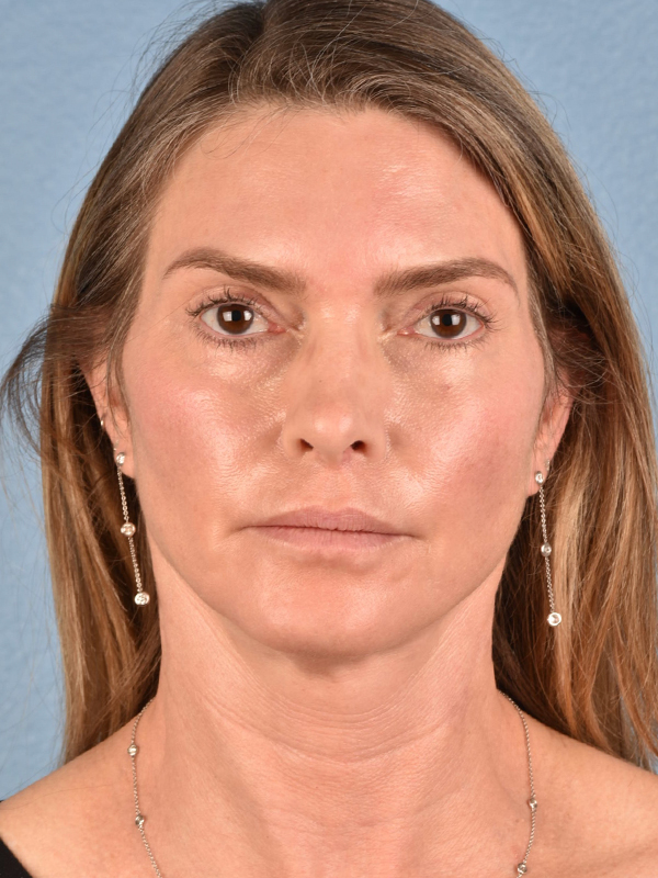 Facelift Before & After Gallery - Patient 127422 - Image 2