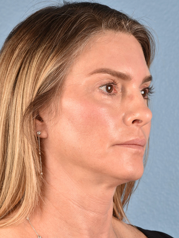 Facelift Before & After Gallery - Patient 127422 - Image 4