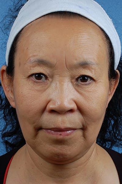 Facelift Before & After Gallery - Patient 401832 - Image 1