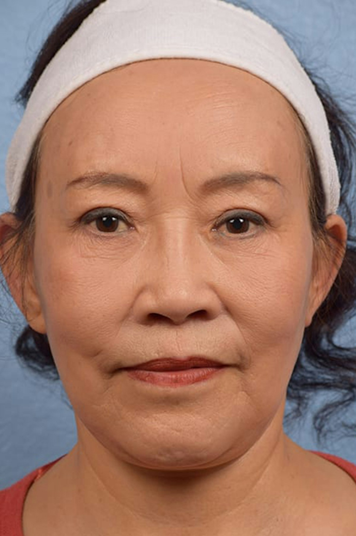 Facelift Before & After Gallery - Patient 401832 - Image 2