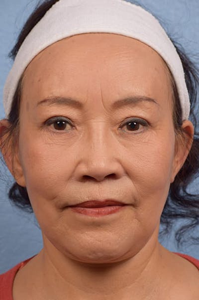 Facelift Before & After Gallery - Patient 401832 - Image 2