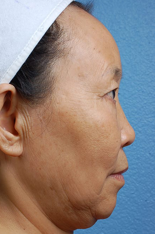 Hidden Patients Before & After Gallery - Patient 408526 - Image 3