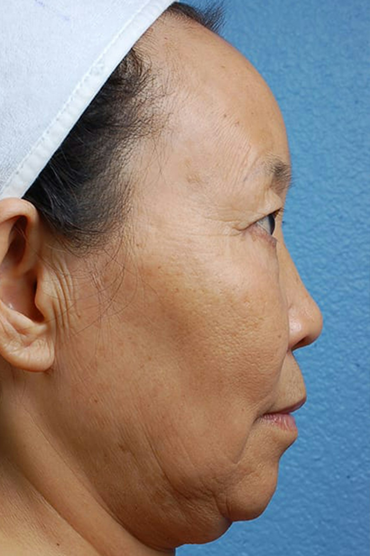 Facelift Before & After Gallery - Patient 401832 - Image 3