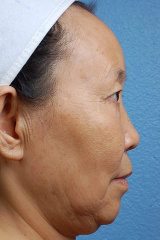 Hidden Patients Before & After Gallery - Patient 408526 - Image 3