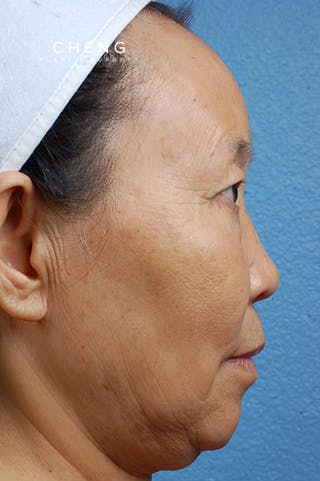 Hidden Patients Before & After Gallery - Patient 408526 - Image 3