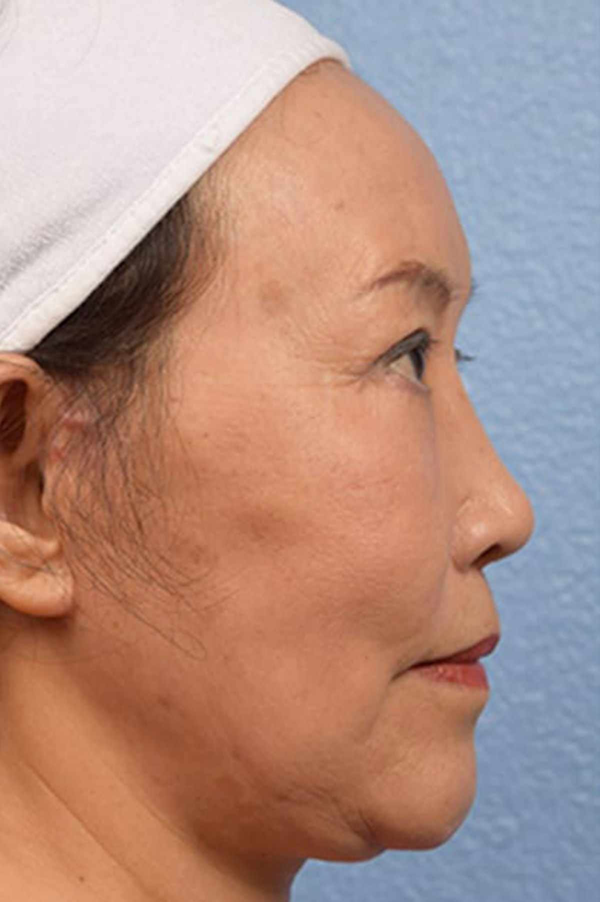 Facelift Before & After Gallery - Patient 401832 - Image 4