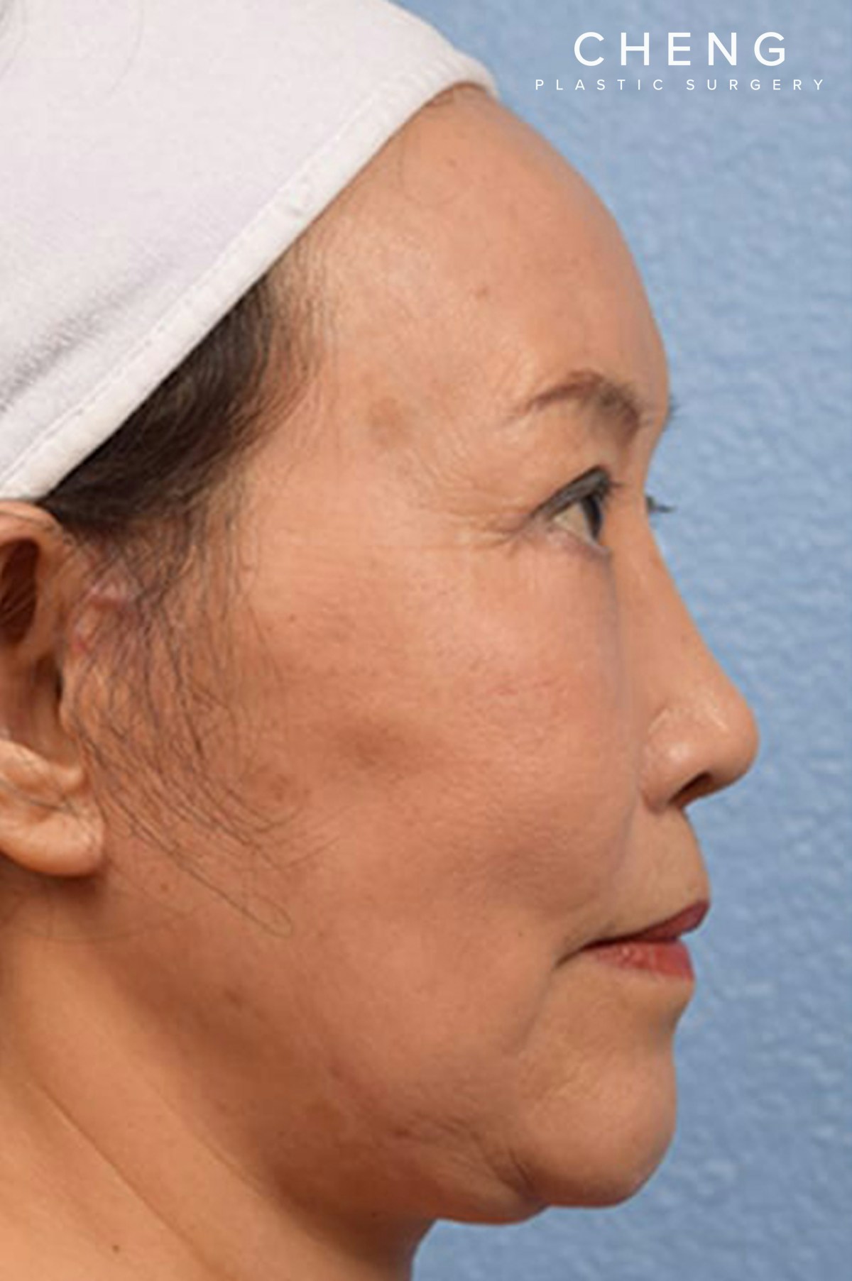 Hidden Patients Before & After Gallery - Patient 408526 - Image 4