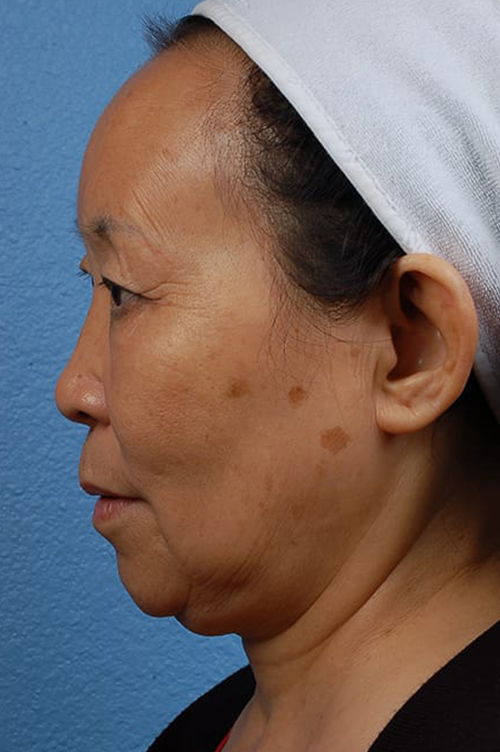 Hidden Patients Before & After Gallery - Patient 408526 - Image 5