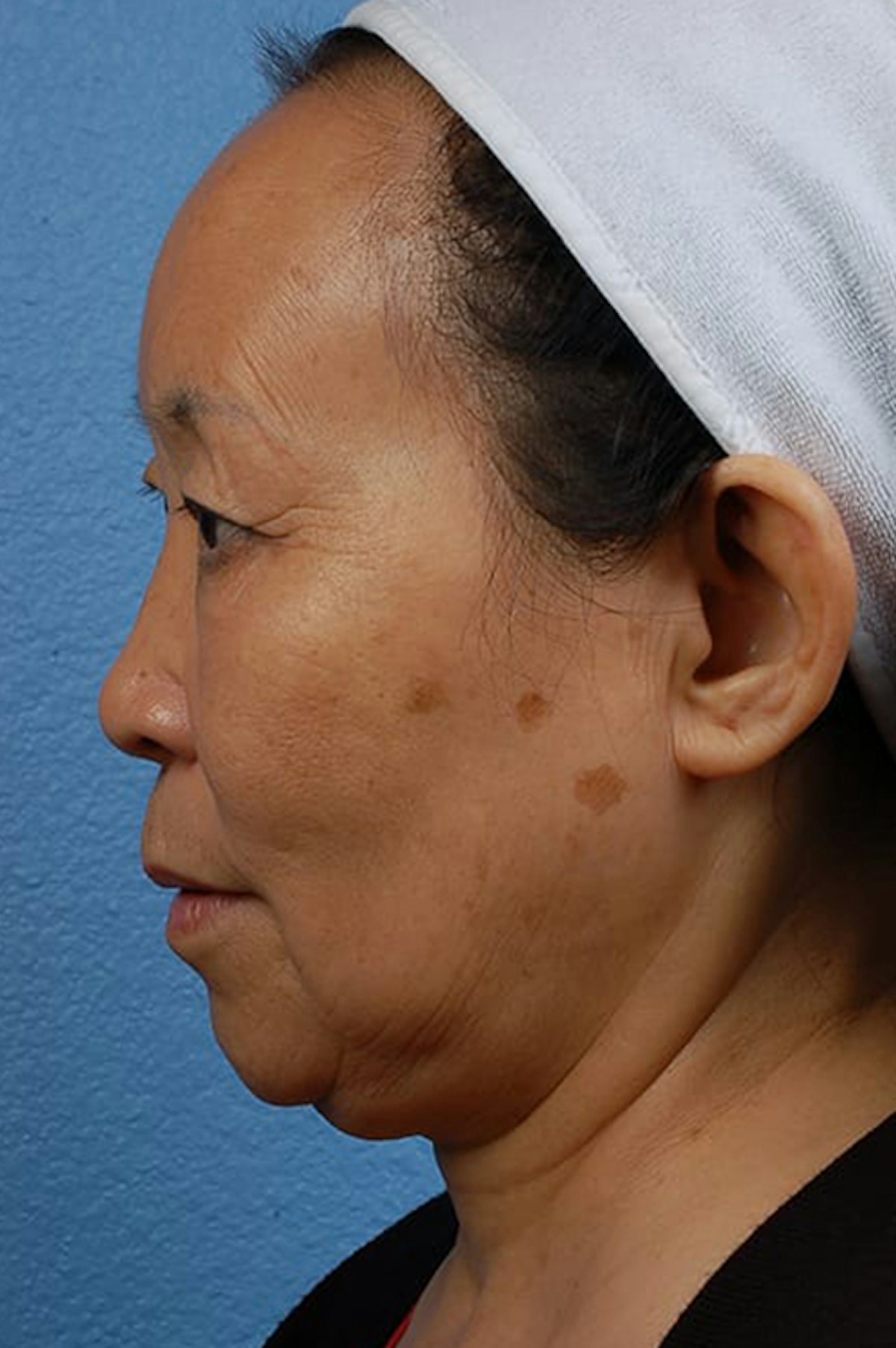 Facelift Before & After Gallery - Patient 401832 - Image 5